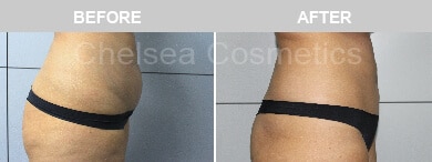 Slim Lipo (women) Before & After Photos - 30