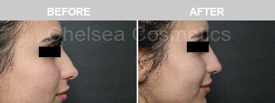 Non-Surgical Rhinoplasty Before & After Photos - 8