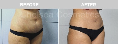 Slim Lipo (women) Before & After Photos - 29