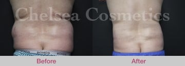 Slim Lipo (men) Before & After Photos - 15
