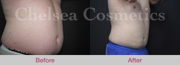 Slim Lipo (men) Before & After Photos - 14