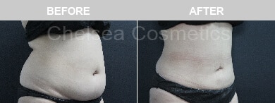 Slim Lipo (women) Before & After Photos - 1