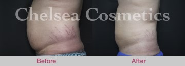 Slim Lipo (men) Before & After Photos - 13