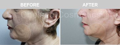 Thread Lift Before & After Photos - 6