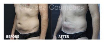 Slim Lipo (men) Before & After Photos - 2