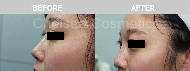 Non-Surgical Rhinoplasty Before & After Photos - 10