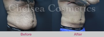 Slim Lipo (men) Before & After Photos - 11