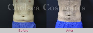 Slim Lipo (men) Before & After Photos - 10