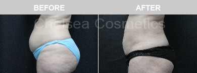 Slim Lipo (women) Before & After Photos - 6