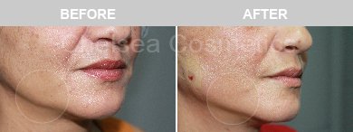 Thread Lift Before & After Photos - 19