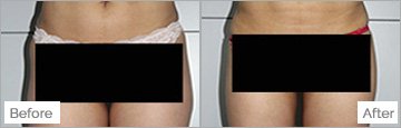 Slim Lipo (women) Before & After Photos - 35