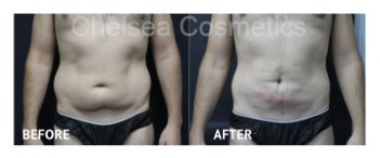 Slim Lipo (men) Before & After Photos - 1