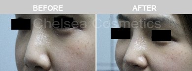Non-Surgical Rhinoplasty Before & After Photos - 13