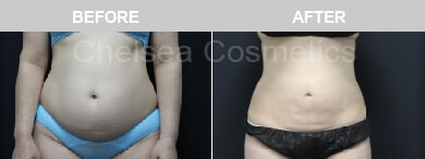 Slim Lipo (women) Before & After Photos - 4