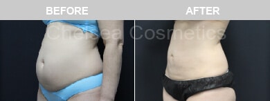 Slim Lipo (women) Before & After Photos - 5