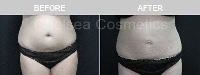 Slim Lipo (women) Before & After Photos - 28