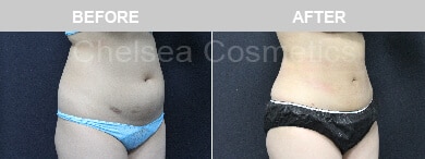 Slim Lipo (women) Before & After Photos - 26