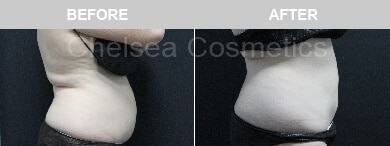 Slim Lipo (women) Before & After Photos - 2