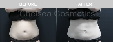 Slim Lipo (women) Before & After Photos - 3