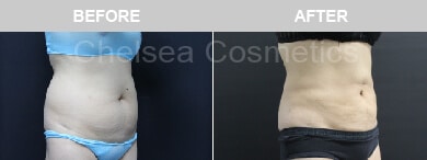 Slim Lipo (women) Before & After Photos - 22