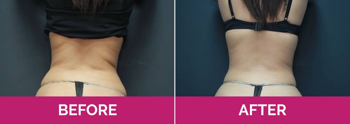 Slim Lipo (women) Before & After Photos - 25