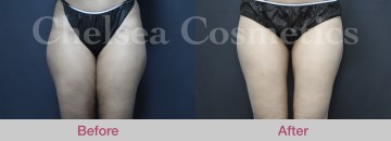 Slim Lipo (women) Before & After Photos - 24