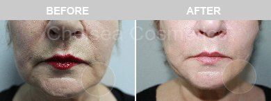 Thread Lift Before & After Photos - 9