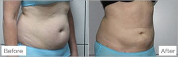 Slim Lipo (women) Before & After Photos - 11