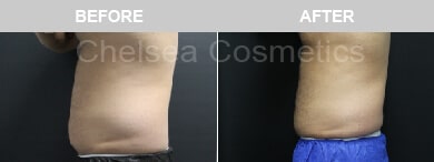 Slim Lipo (men) Before & After Photos - 24
