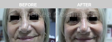 Non-Surgical Rhinoplasty Before & After Photos - 16