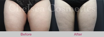Slim Lipo (women) Before & After Photos - 18