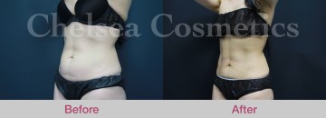 Slim Lipo (women) Before & After Photos - 17