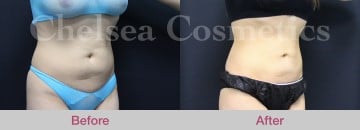 Slim Lipo (women) Before & After Photos - 14