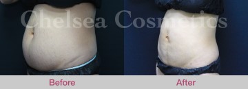 Slim Lipo (women) Before & After Photos - 15