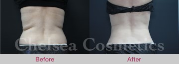 Slim Lipo (women) Before & After Photos - 20
