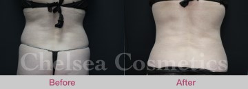 Slim Lipo (women) Before & After Photos - 19