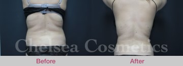 Slim Lipo (women) Before & After Photos - 13