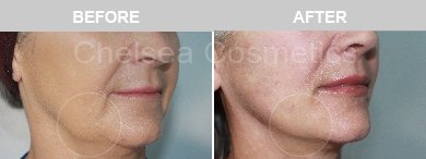 Thread Lift Before & After Photos - 3