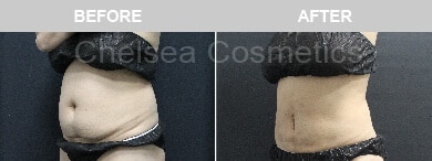 Slim Lipo (women) Before & After Photos - 34