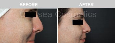 Non-Surgical Rhinoplasty Before & After Photos - 18