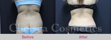 Slim Lipo (women) Before & After Photos - 21