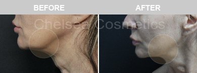 Thread Lift Before & After Photos - 10