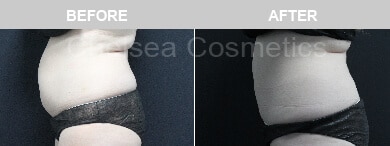 Slim Lipo (women) Before & After Photos - 36