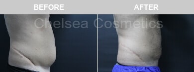 Slim Lipo (men) Before & After Photos - 21