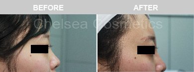 Non-Surgical Rhinoplasty Before & After Photos - 17