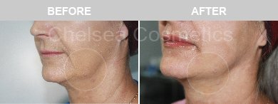 Thread Lift Before & After Photos - 7