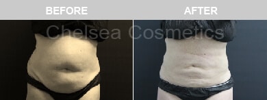 Slim Lipo (women) Before & After Photos - 10