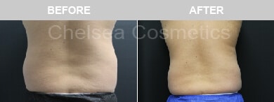 Slim Lipo (men) Before & After Photos - 22