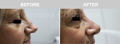 Non-Surgical Rhinoplasty Before & After Photos - 15