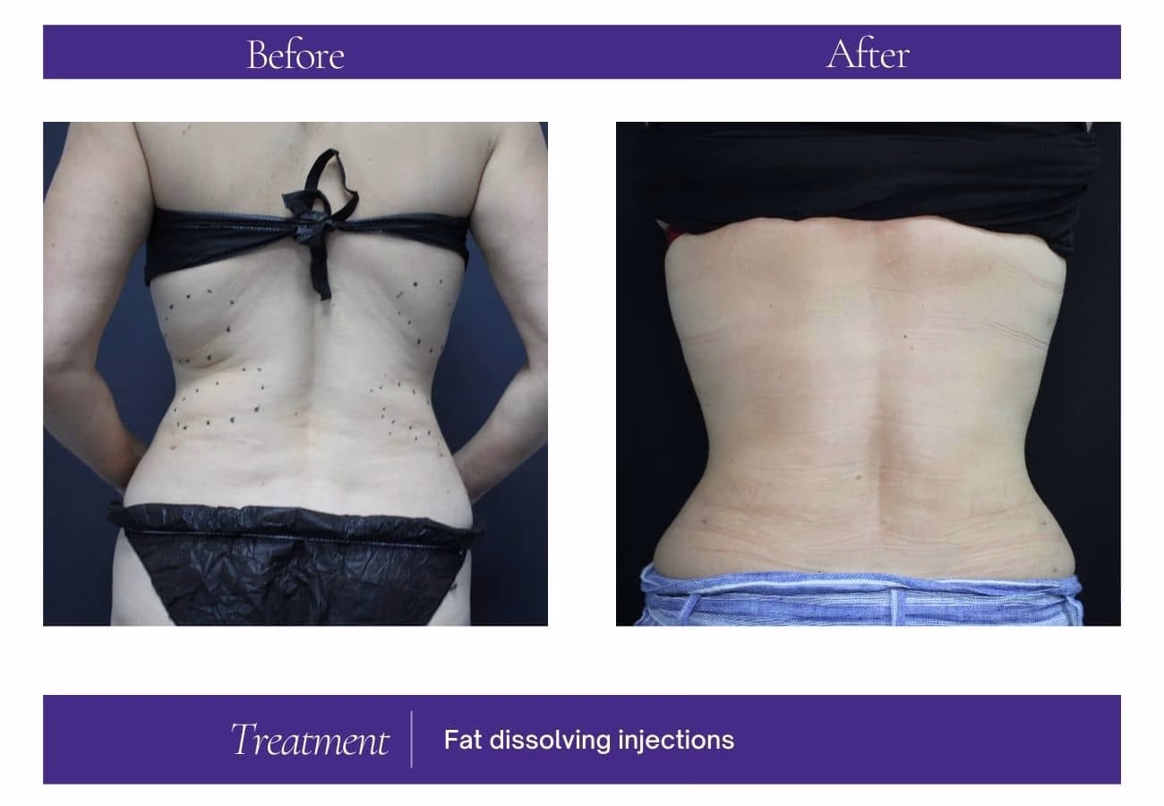 fat dissolving injection example